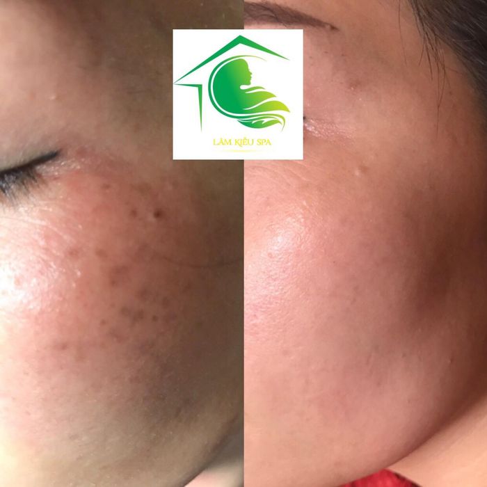 Hình ảnh thực tế quy trình điều trị tại Lâm Kiều Spa