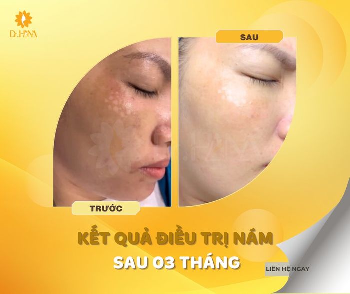 Hình ảnh thực tế quy trình điều trị tại Dr. Hana