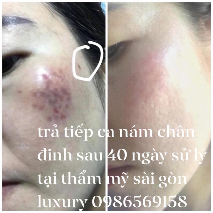 Quy trình điều trị chuyên nghiệp với công nghệ Nano tiên tiến