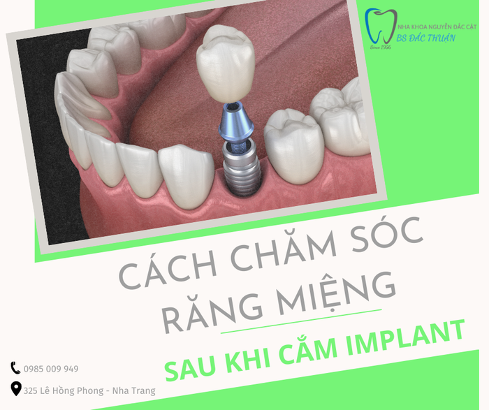 Hình ảnh 2 - Quy trình trồng răng chuẩn quốc tế