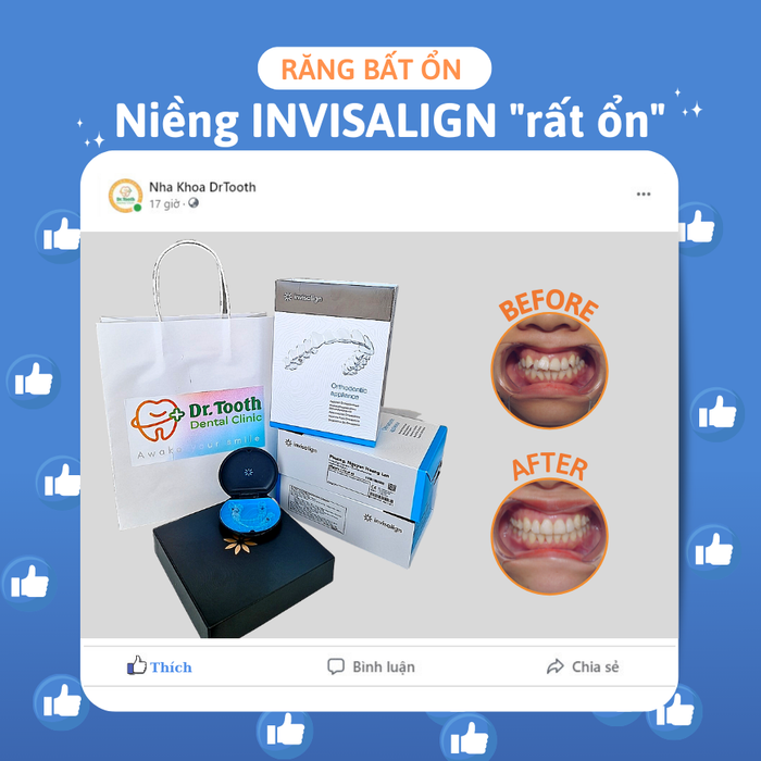 Hình ảnh 2 - Quy trình cấy ghép chuẩn quốc tế tại Nha khoa Dr.Tooth
