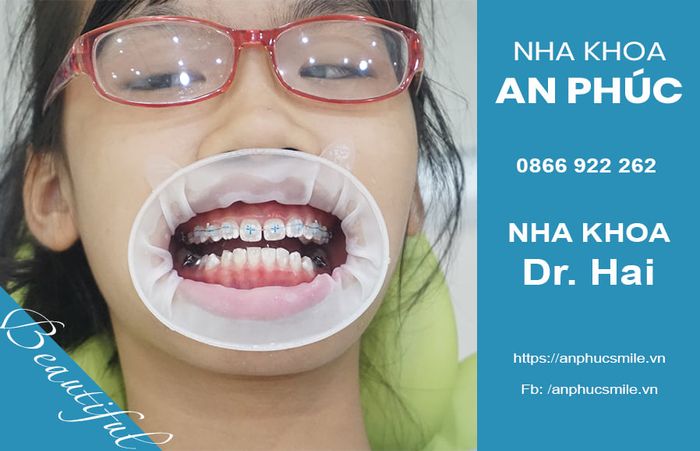 Hình ảnh 3 - Quy trình thăm khám chuyên nghiệp tại Nha Khoa An Phúc