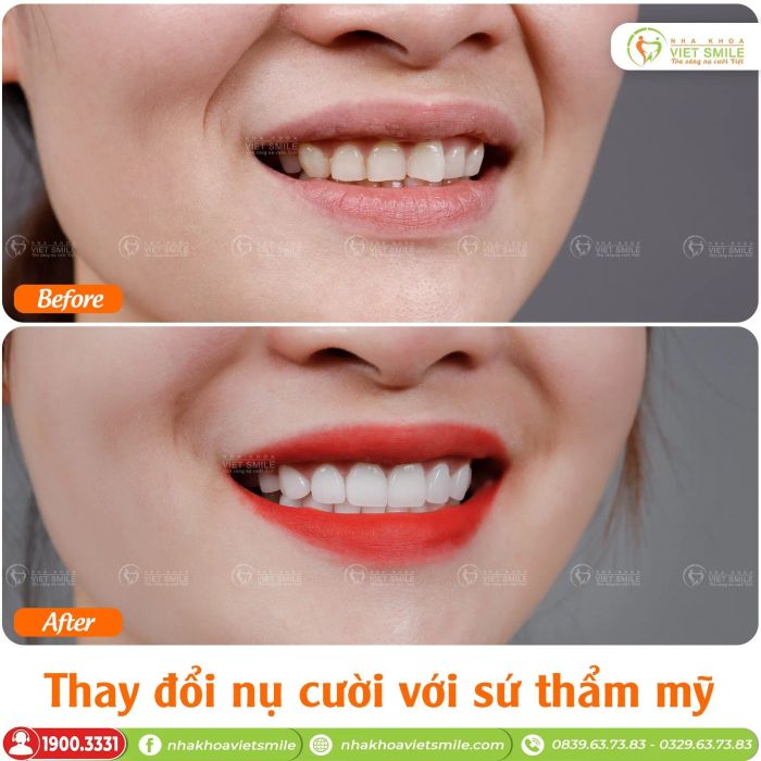 Hình ảnh quy trình bọc răng sứ chuẩn quốc tế tại VIET SMILE