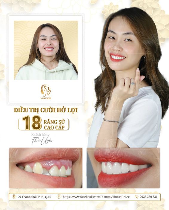 Hình ảnh quy trình thẩm mỹ răng sứ tại Vincos & Dr Lee