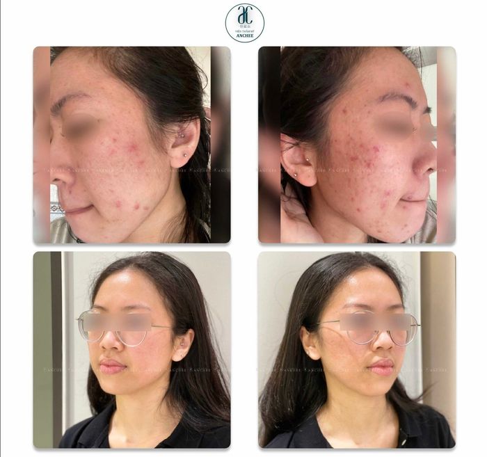 Hình ảnh công nghệ Bio Light trị mụn tại AnChee Clinic