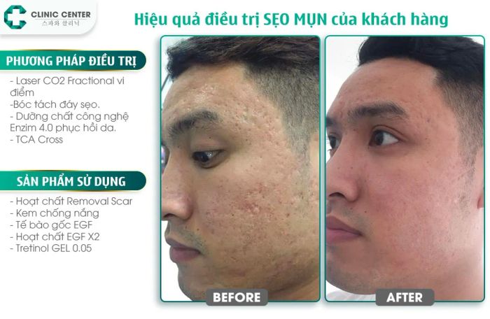 Hình ảnh điều trị sẹo rỗ tại C Clinic Center