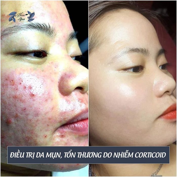 Hình ảnh quy trình điều trị chuyên nghiệp tại Nami Spa Beauty & Clinic