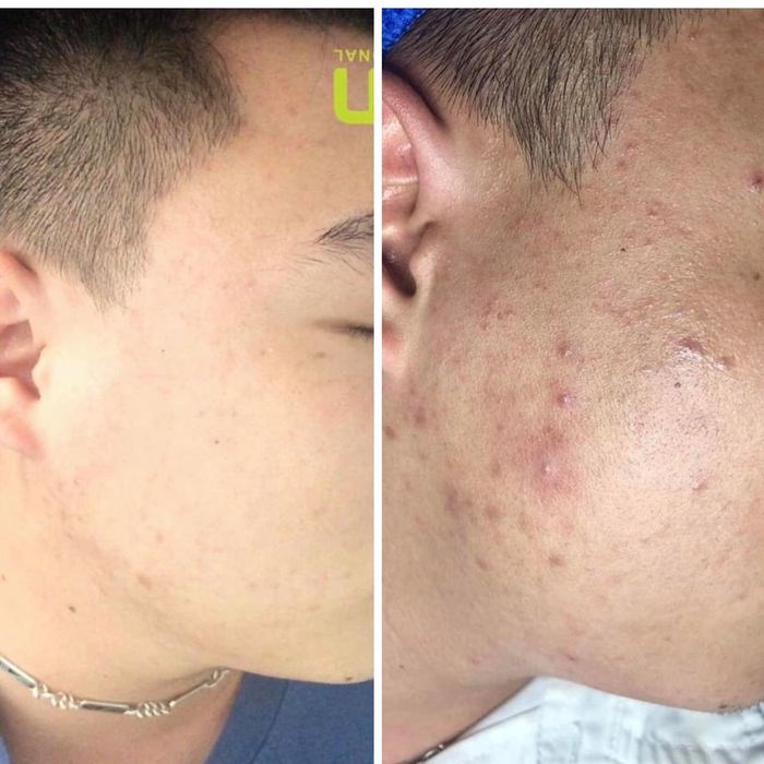 Hình ảnh quy trình trị liệu chuyên nghiệp tại Suri Spa Hải Phòng
