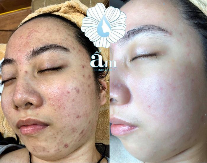 Hình ảnh quy trình trị liệu chuyên nghiệp tại Ẩm Clinic & Spa
