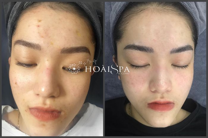 Hình ảnh quy trình điều trị chuyên nghiệp tại Hoài Spa & Clinic