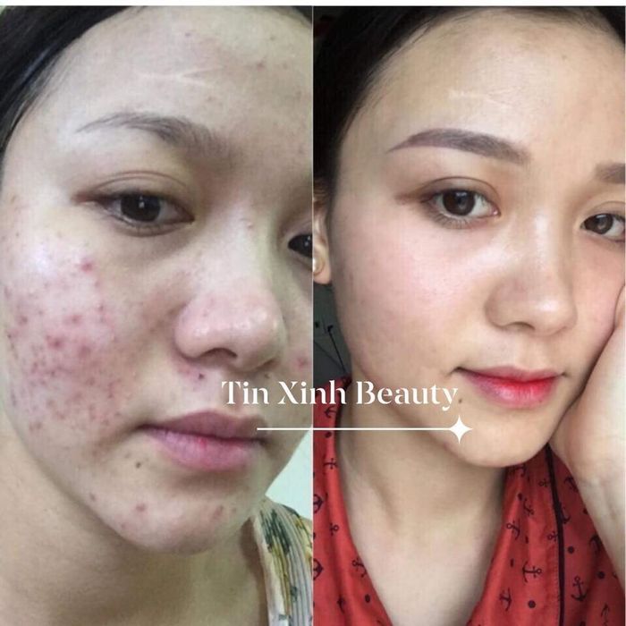 Quy trình điều trị chuẩn y khoa tại Tin Xinh Beauty