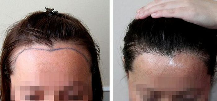 Kết quả cấy tóc thực tế tại Thẩm mỹ viện Bác sĩ Hà Thanh