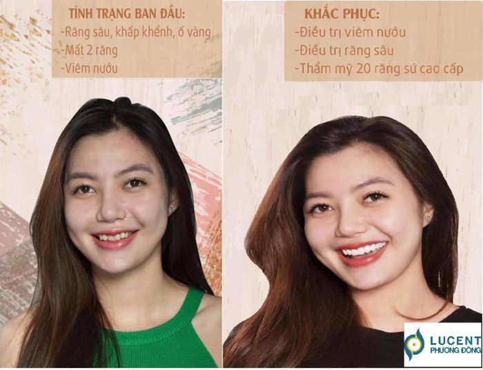 Hình ảnh thực tế quy trình bọc răng sứ tại Lucent Phương Đông