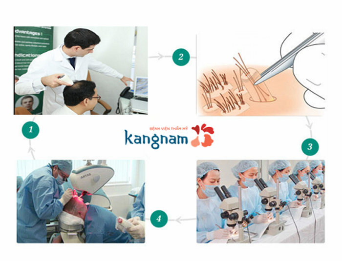 Hình ảnh thực tế về quy trình cấy tóc tại BVTM Kangnam