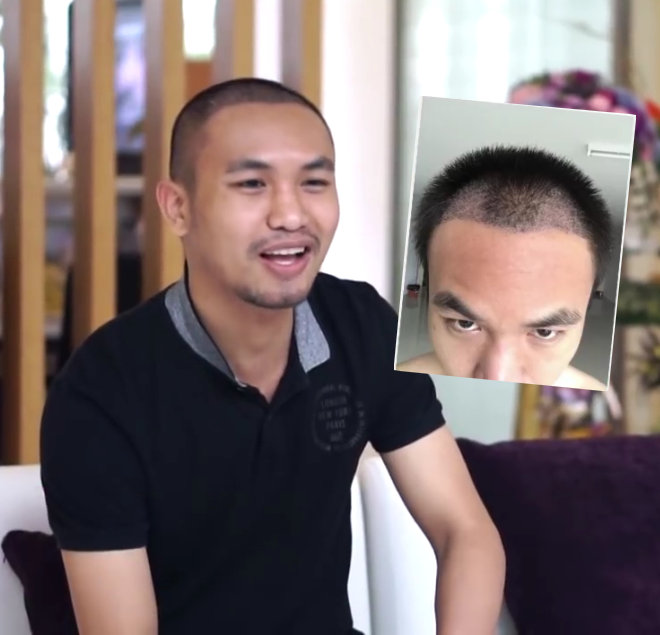 Kết quả cấy tóc thực tế tại Smile Hair