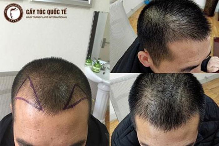 Hình ảnh quy trình cấy tóc FUE thế hệ 4 tại phòng khám