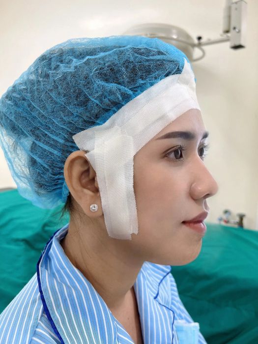 Là con gái nhưng mũi bị gồ, phải làm sao? ảnh 2