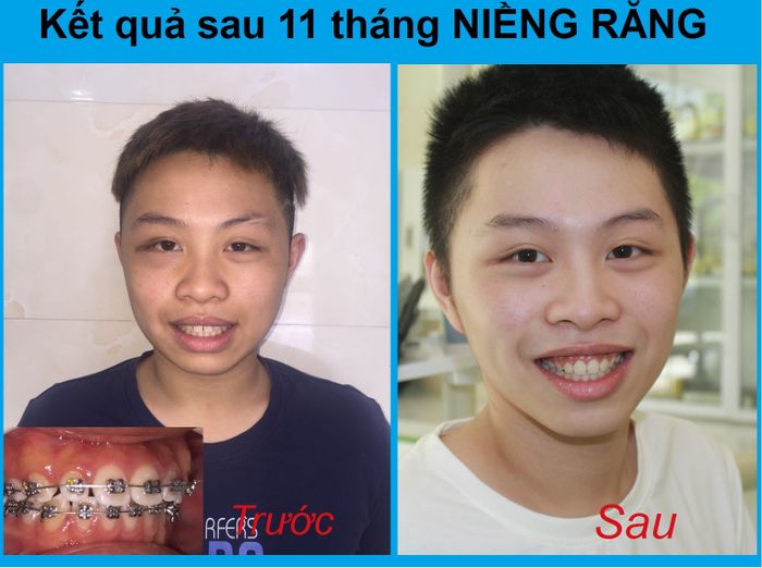 Hình ảnh quy trình niềng răng chuyên nghiệp tại Việt Mỹ