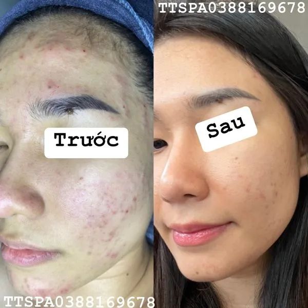 TT Spa - Chăm Sóc Da Chuyên Nghiệp ảnh 2