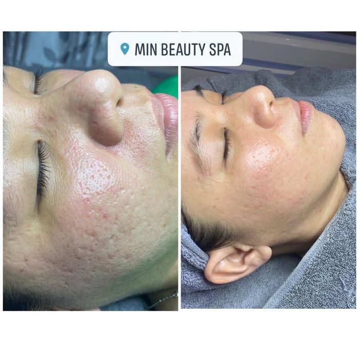 Quy trình trị mụn chuyên nghiệp tại Min Beauty Spa