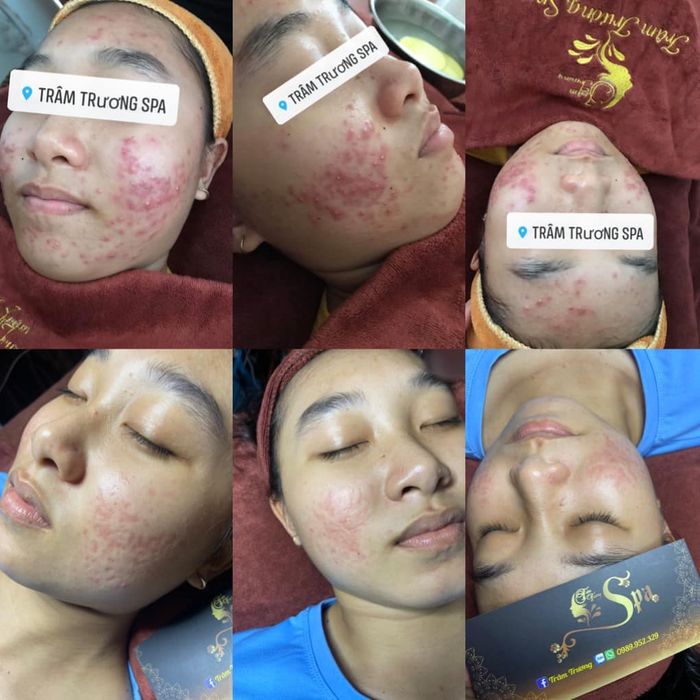 Quy trình trị mụn chuẩn y khoa tại Spa Trâm Trương