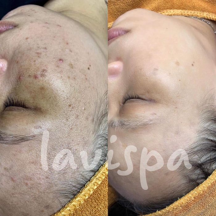 Hình ảnh liệu trình trị mụn chuyên sâu tại Lavi Spa
