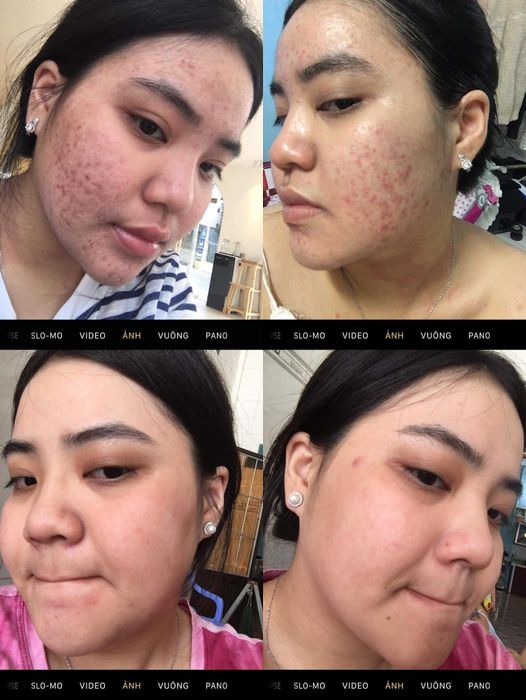 Quy trình trị mụn chuyên nghiệp tại Dung Ana Spa