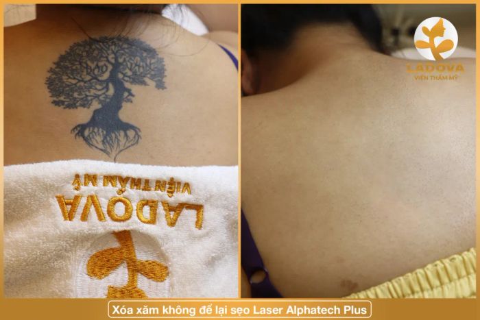 Hình ảnh thực tế về quy trình xóa xăm tại Viện Thẩm Mỹ Ladova