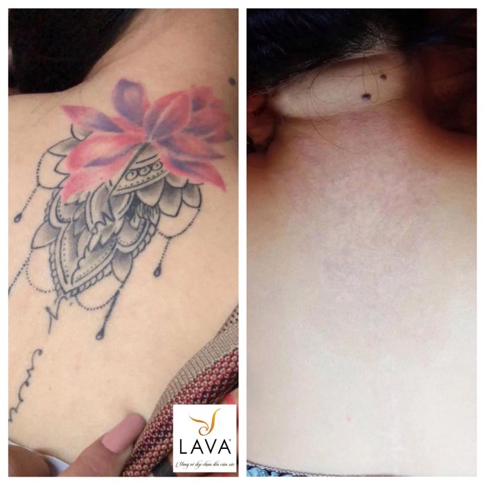 Hình ảnh thực tế quy trình xóa xăm tại Thẩm Mỹ Viện LAVA