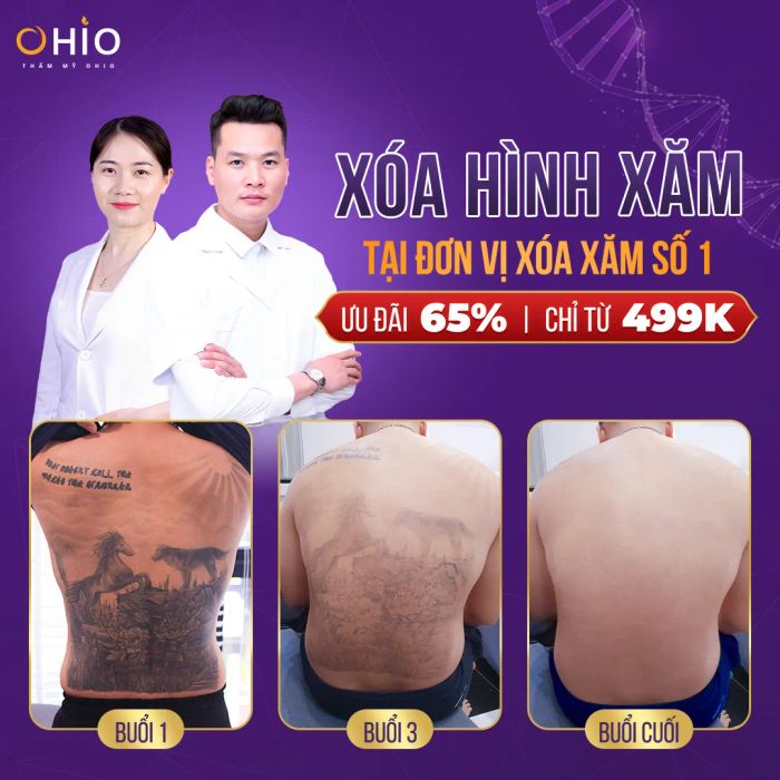 Hình ảnh thực tế thành công từ công nghệ xóa xăm đột phá tại Thẩm mỹ OHIO