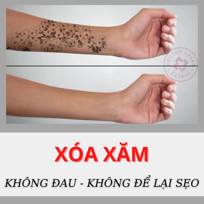 Hình ảnh thực tế quy trình xóa xăm tại Doctor Laser