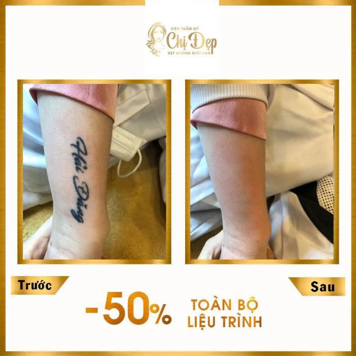 Kết quả xóa xăm ấn tượng tại Viện Thẩm Mỹ Chị Đẹp