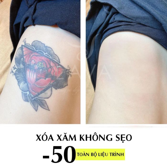 Kết quả xóa xăm ấn tượng tại Thẩm Mỹ Viện LAVA