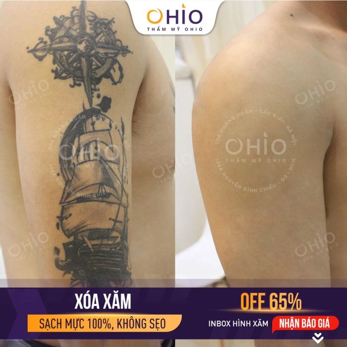 Hình ảnh thực tế kết quả xóa xăm ấn tượng tại Thẩm mỹ OHIO