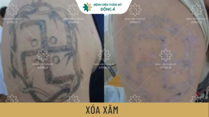 Kết quả xóa xăm ấn tượng bằng công nghệ cao tại Đông Á