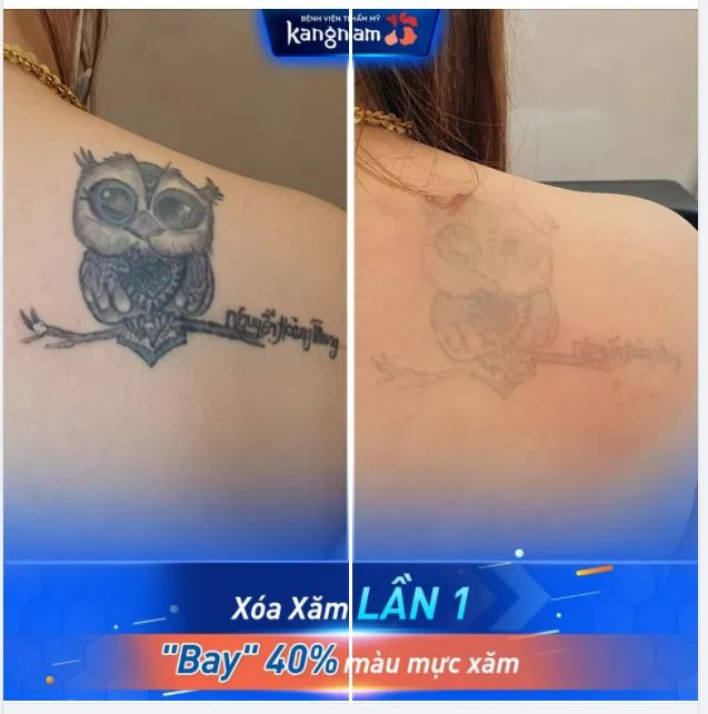 Kết quả xóa xăm ấn tượng bằng công nghệ Laser Picosure tại Kangnam
