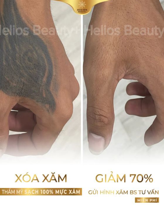 Hình ảnh khách hàng trước và sau khi xóa xăm tại Helios Beauty +