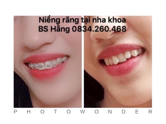 Nha khoa Bác sĩ Hằng Thái Nguyên ảnh 2