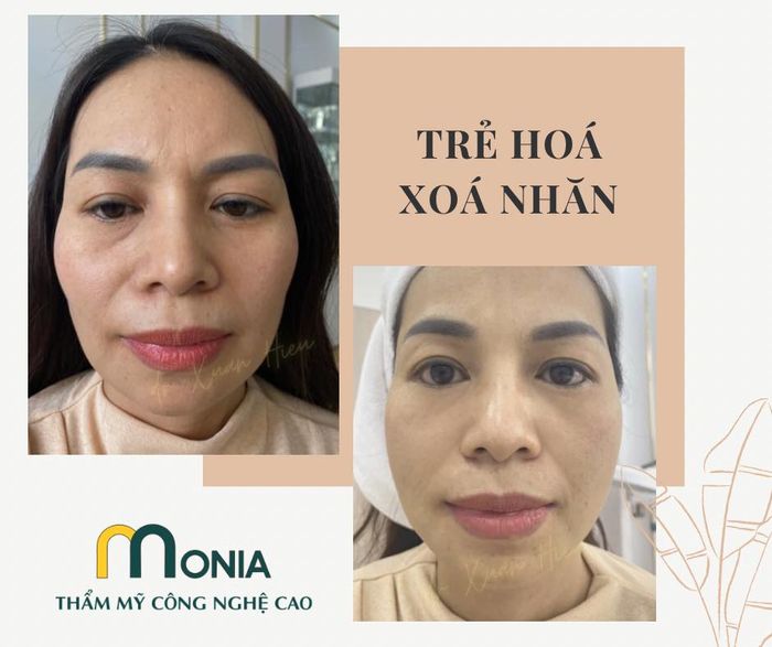 Thẩm mỹ công nghệ cao Monia - Hình ảnh 2