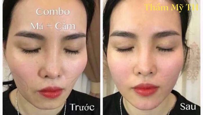 Hình ảnh thực tế dịch vụ tại Thẩm Mỹ TH