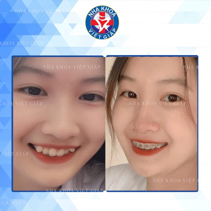 Nha Khoa Việt Giáp Thái Nguyên ảnh 2