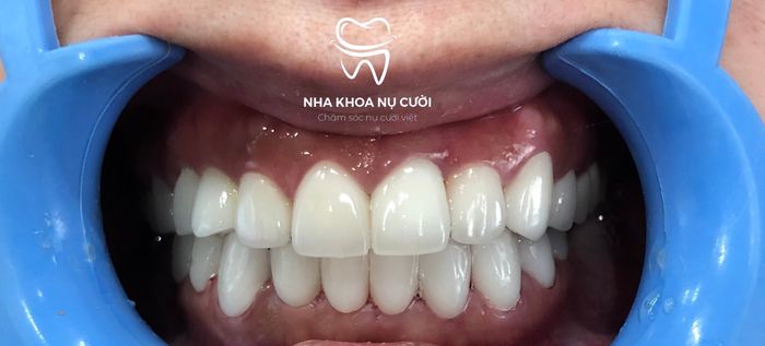 Hình ảnh thực tế về quy trình niềng răng chuyên nghiệp tại Nha Khoa Nụ Cười Đà Lạt