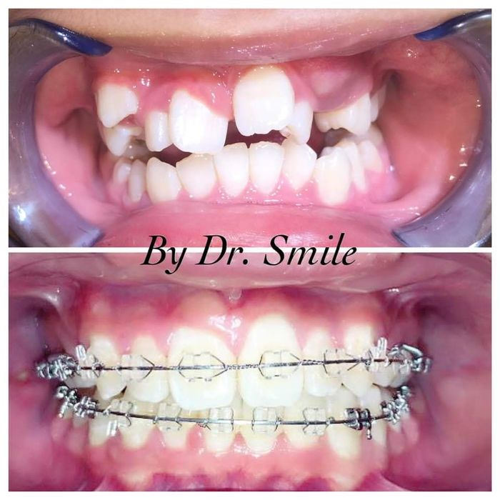 Hình ảnh thực tế về quy trình niềng răng chuyên nghiệp tại Nha Khoa Dr. Smile Đà Lạt