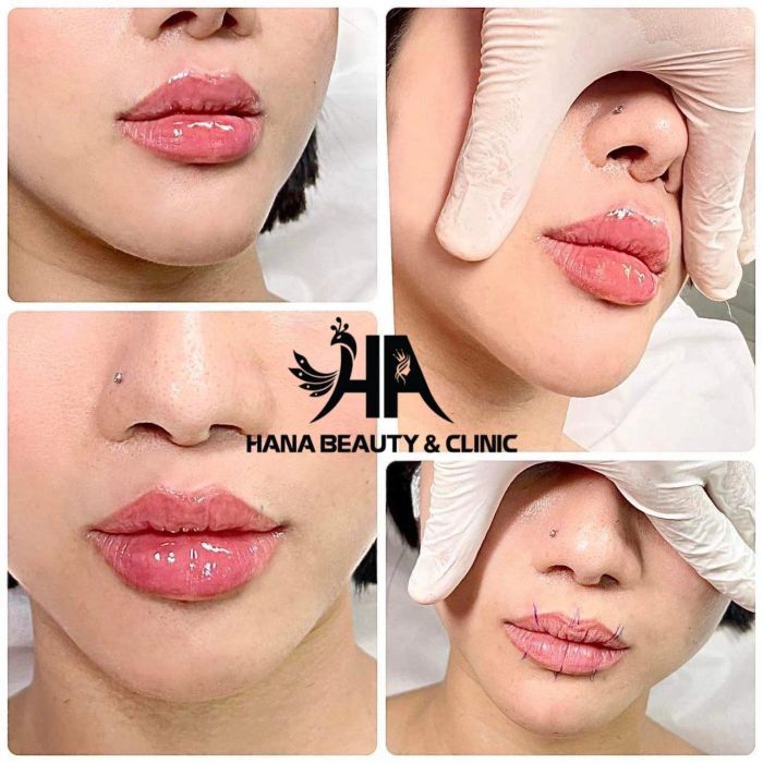 Hình ảnh thực tế dịch vụ tại Hana Beauty & Clinic