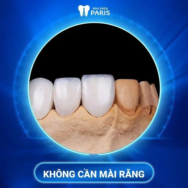 Quy trình dán sứ Veneer chuyên nghiệp tại Nha khoa Paris