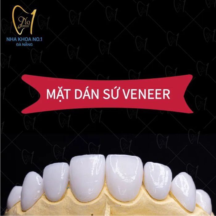 Hình ảnh thực tế quy trình dán sứ veneer tại Nha khoa No1