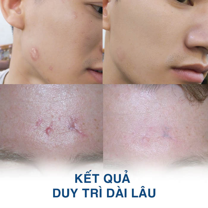 Quy trình trị sẹo lồi bằng công nghệ Triam tại Sky Diamond