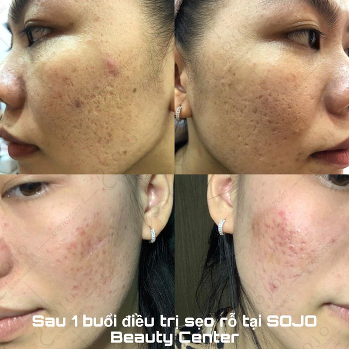 Hình ảnh trị liệu chuyên nghiệp tại SOJO Beauty Center