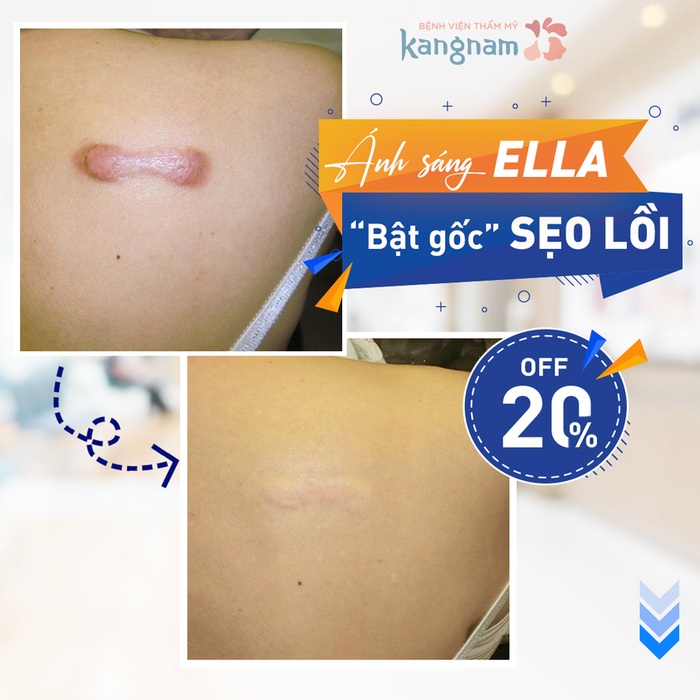 Không gian điều trị sẹo lồi chuẩn Hàn tại Kangnam