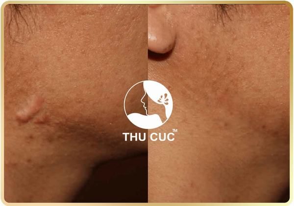 Quy trình trị sẹo lồi chuyên nghiệp tại Thu Cúc Clinics